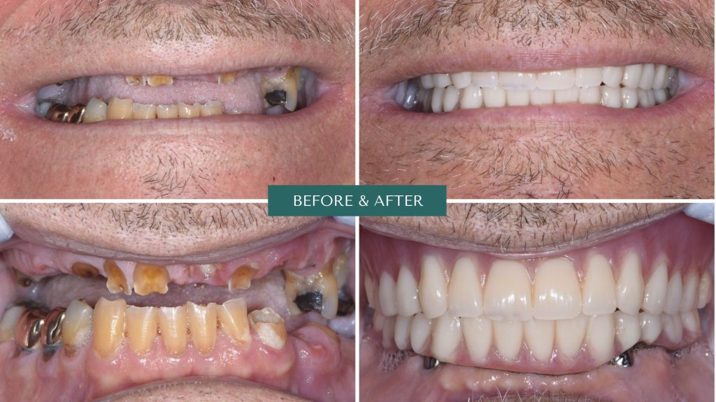 Before and after of prosthodontic treatment using MK1 on upper and Hybrid on Lower