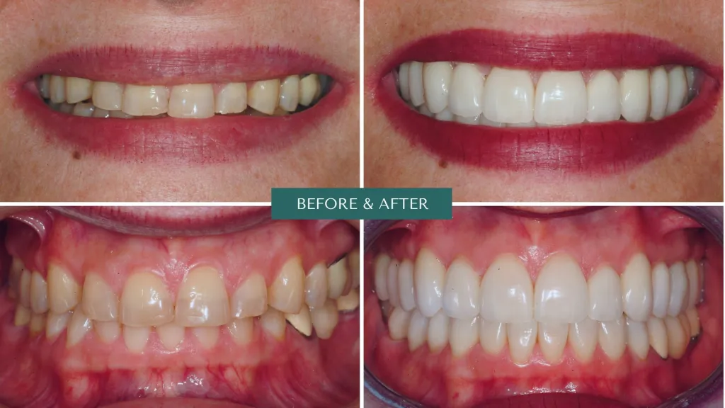 Prosthodontic treatment before and after photos with crown and bridge restorations